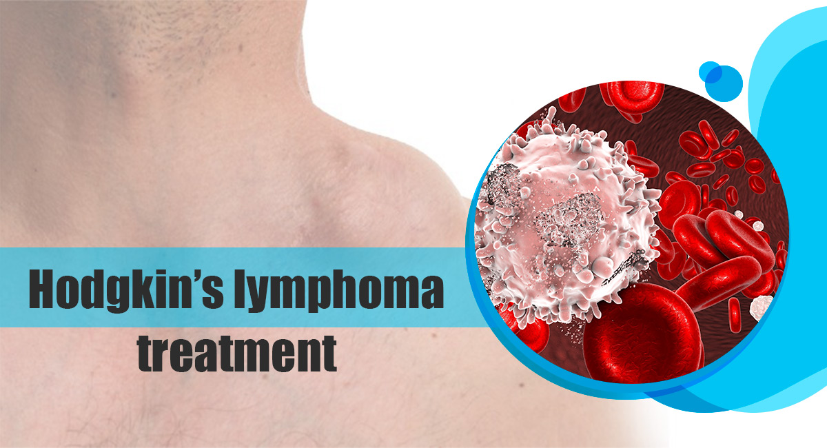 Hodgkin’s Lymphoma Treatment