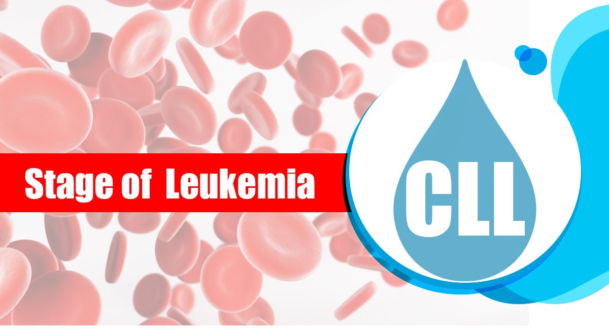 stages of chronic lymphocytic leukemia