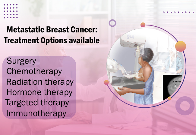 Metastatic Breast Cancer Treatment Options available
