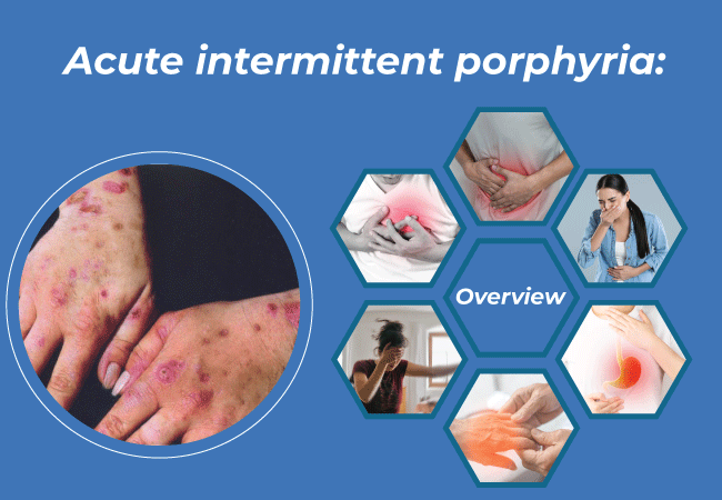 Acute intermittent porphyria Overview