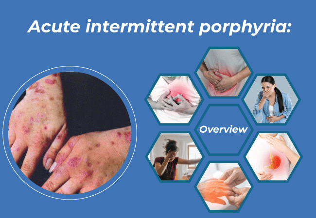 Acute intermittent porphyria