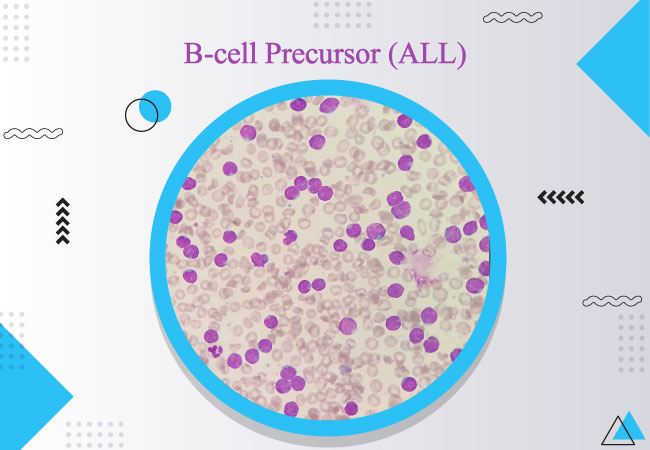 B-cell Precursor ALL Treatment with Blincyto