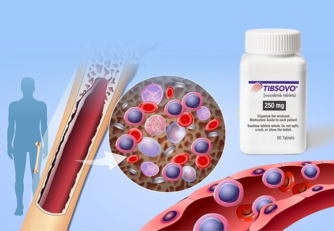 Acute Myeloid Leukemia