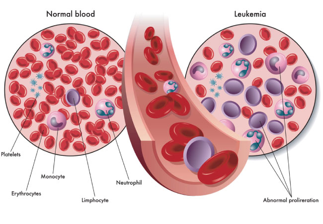 Unveiling ALL Treatment: Navigating Hypersensitivity to Oncaspar