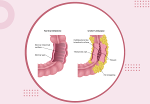 crohn's-disease