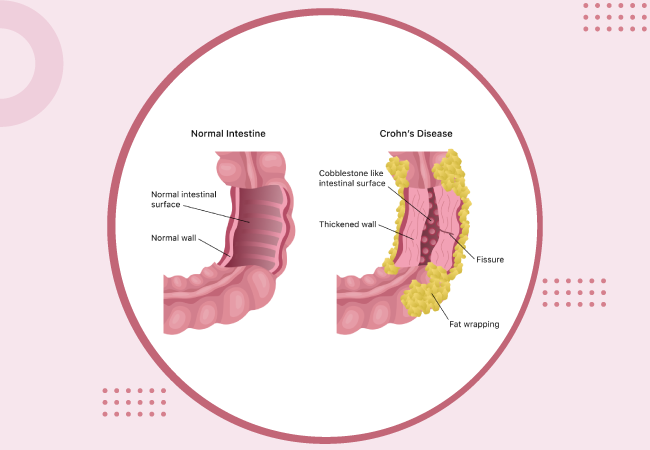 Crohn’s Disease Overview