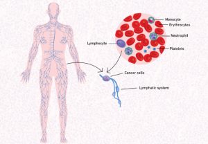 diffuse large B-cell lymphoma (DLBCL).