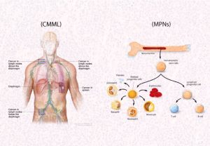 Chronic Myelomonocytic Leukemia vs Myeloproliferative Neoplasms