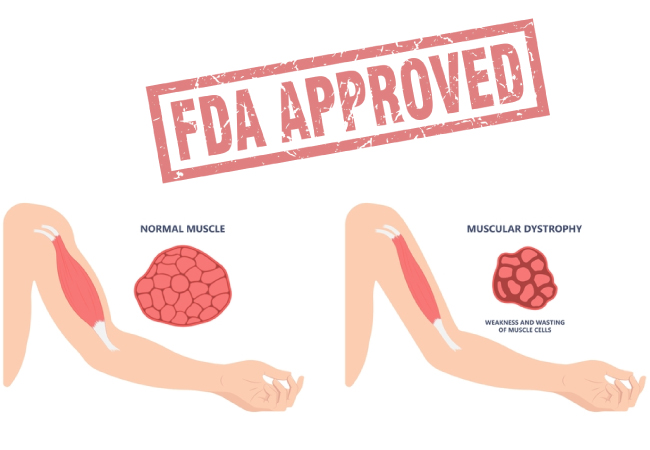 A Breakthrough for Duchenne Muscular Dystrophy: FDA Approves New Treatment
