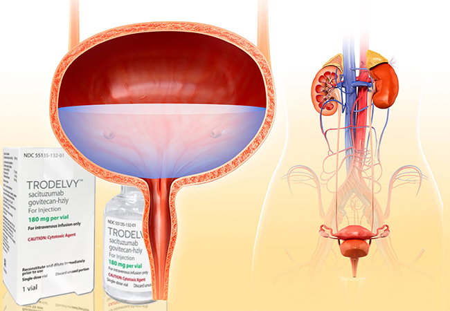 Trodelvy’s Role: Assessing Its Effectiveness in Urothelial Cancer Treatment