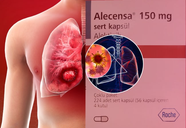 FDA Approves Alectinib as First Adjuvant ALK Inhibitor for Early-Stage NSCLC