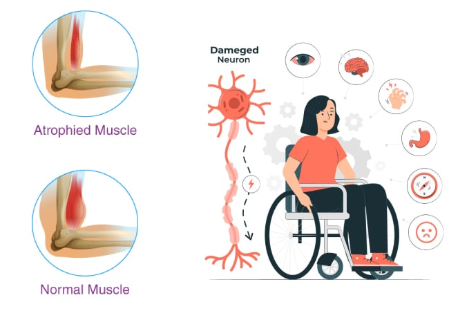 Everything You Need To Know About Duchenne Muscular Dystrophy (DMD)