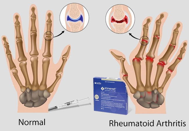 All About Kineret Treatment for Rheumatoid Arthritis (RA), NOMID, and DIRA