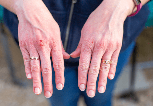 MPOX Virus Truths: Is It a Real Public Health Threat or a Hoax?