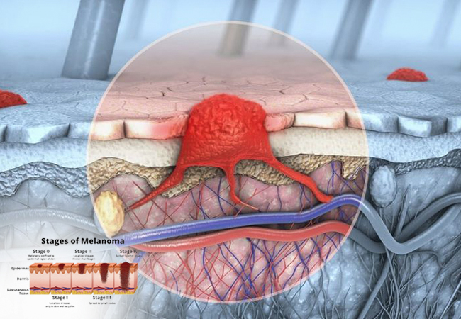 Melanoma: Understanding the Cancer and a Treatment Option Braftovi