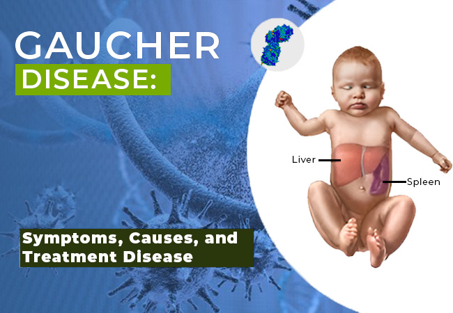 What is Gaucher’s Disease?: Symptoms, Causes, and Treatment