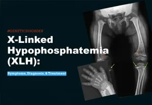 X-Linked Hypophosphatemia (XLH) IN INDIA