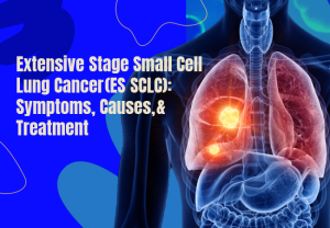 Extensive‑Stage Small Cell Lung Cancer (ES‑SCLC): Symptoms, Causes, & Treatment