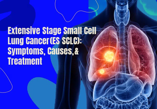 Extensive‑Stage Small Cell Lung Cancer (ES‑SCLC): Symptoms, Causes, & Treatment