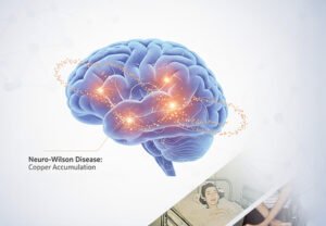 Treatment of Wilson’s Disease