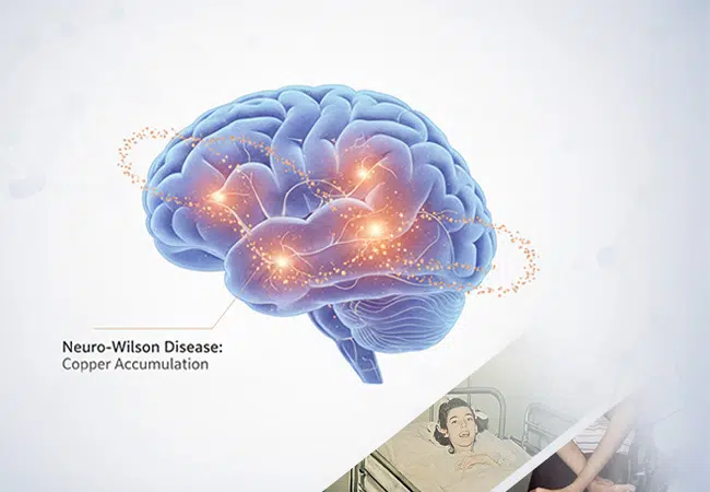 Wilson’s Disease: Neurological Symptoms, Early Signs, and Treatment Options