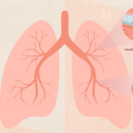 lung cancer