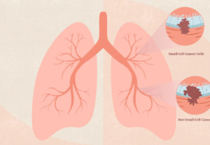 lung cancer